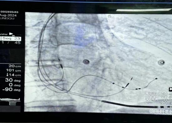 心脏固定在什么地方哈医大二院心内科完成东北三省首例ASQ电极左室主动电极植入_https://www.jmylbn.com_新闻资讯_第4张